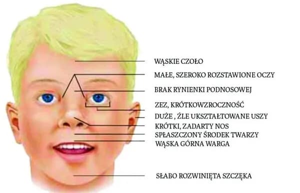 Zespół FAS: Niepokojące objawy, które musisz znać i rozumieć